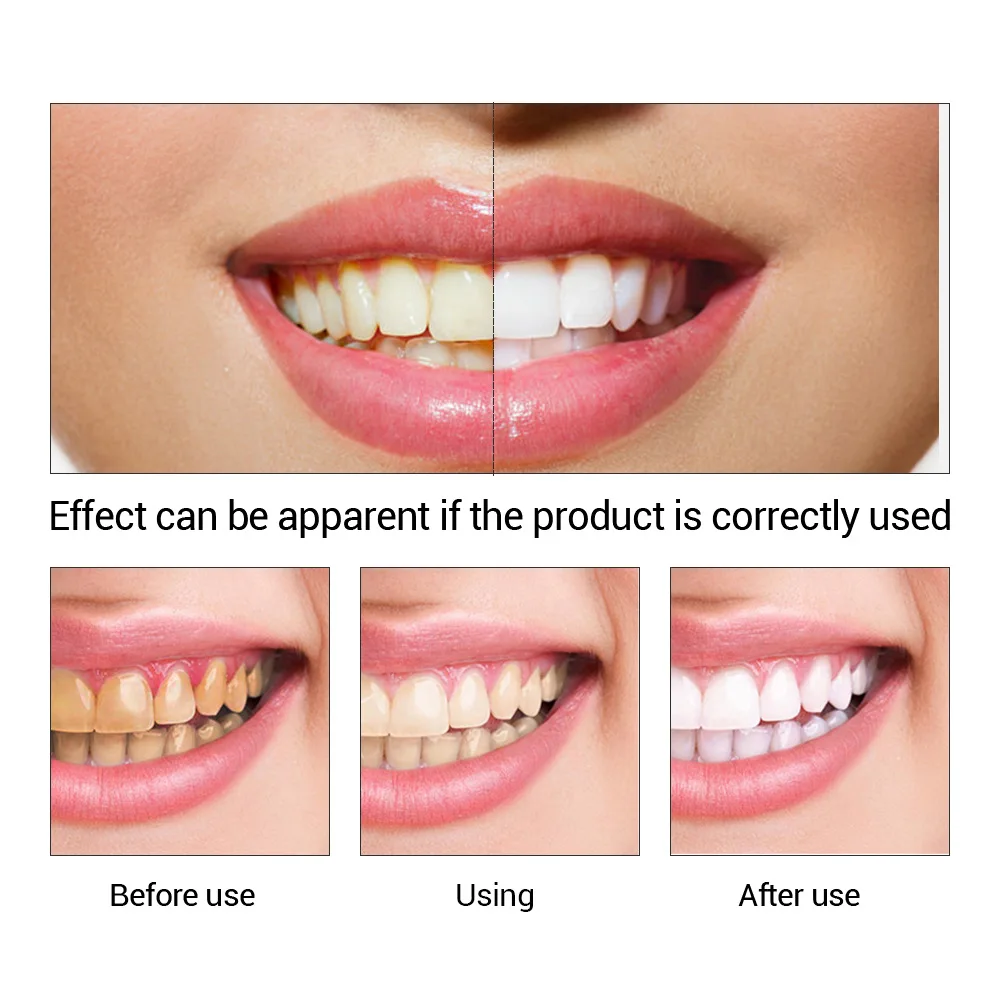 FTEENPLY diş beyazlatma özü to - Teeth Whitening Clinic incelemesi ve fiyatı